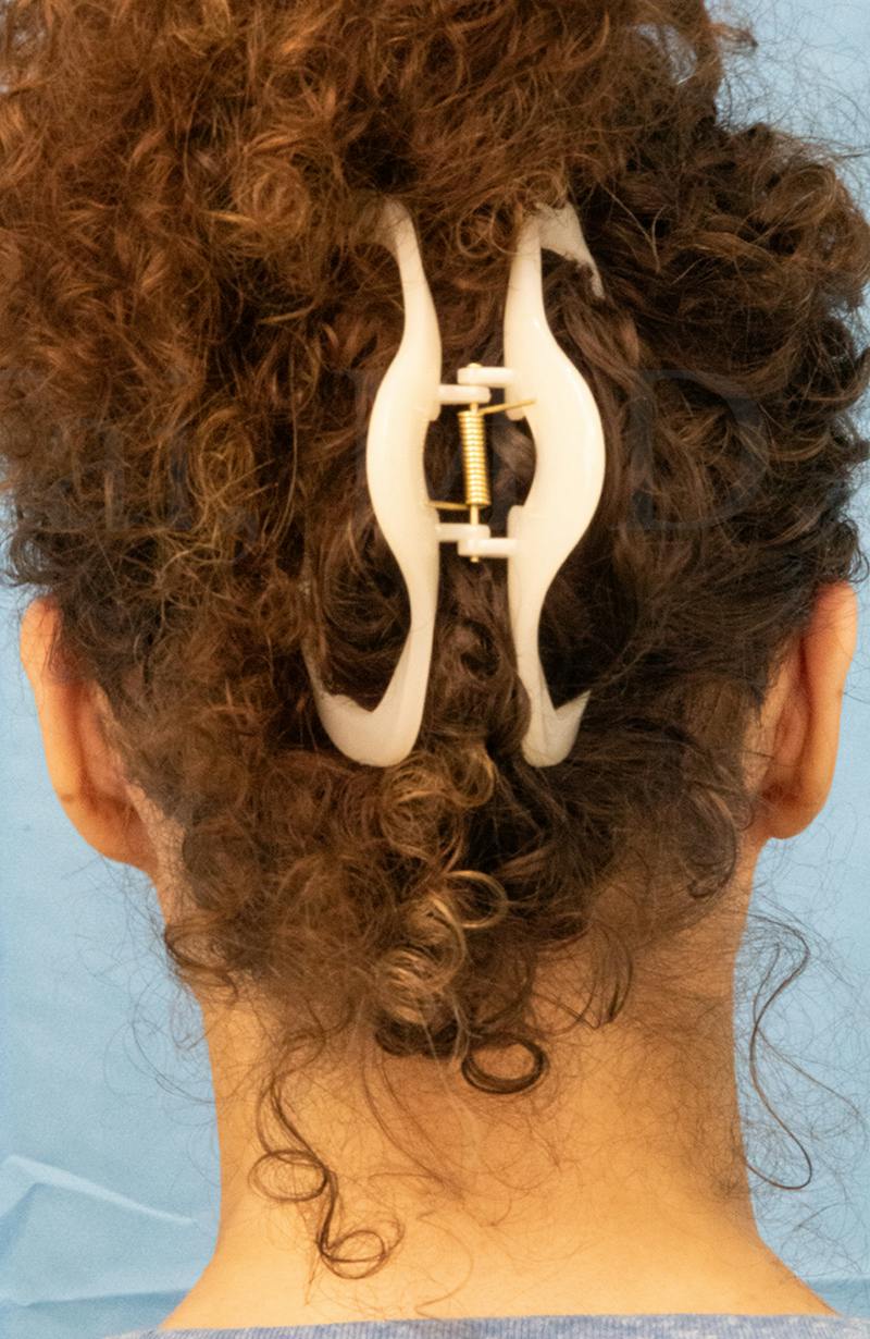 Minor Surgery Before & After Gallery - Patient 281714 - Image 4