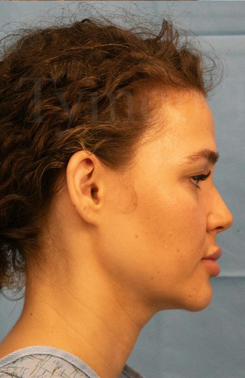 Minor Surgery Before & After Gallery - Patient 281714 - Image 5