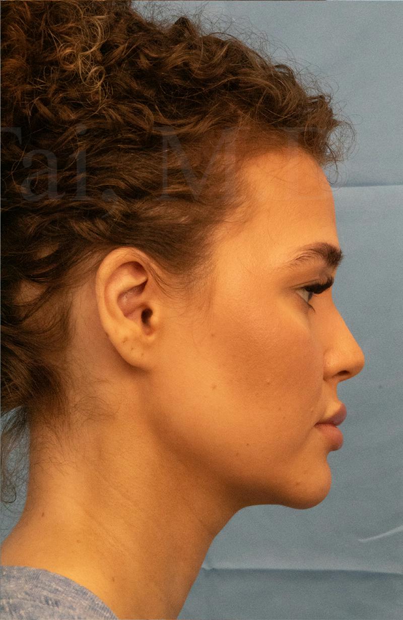 Minor Surgery Before & After Gallery - Patient 281714 - Image 6