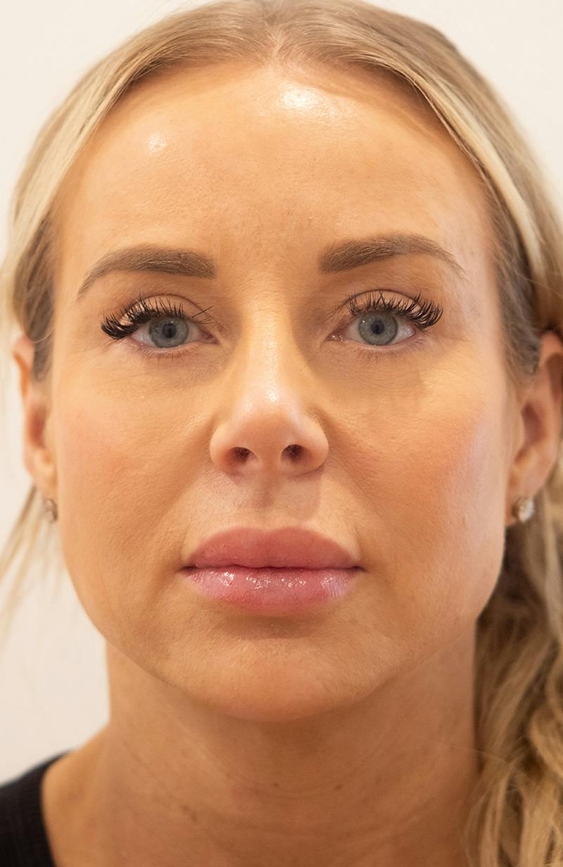 Blepharoplasty Before & After Gallery - Patient 119084 - Image 2