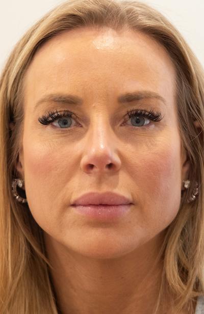Blepharoplasty Before & After Gallery - Patient 119084 - Image 1