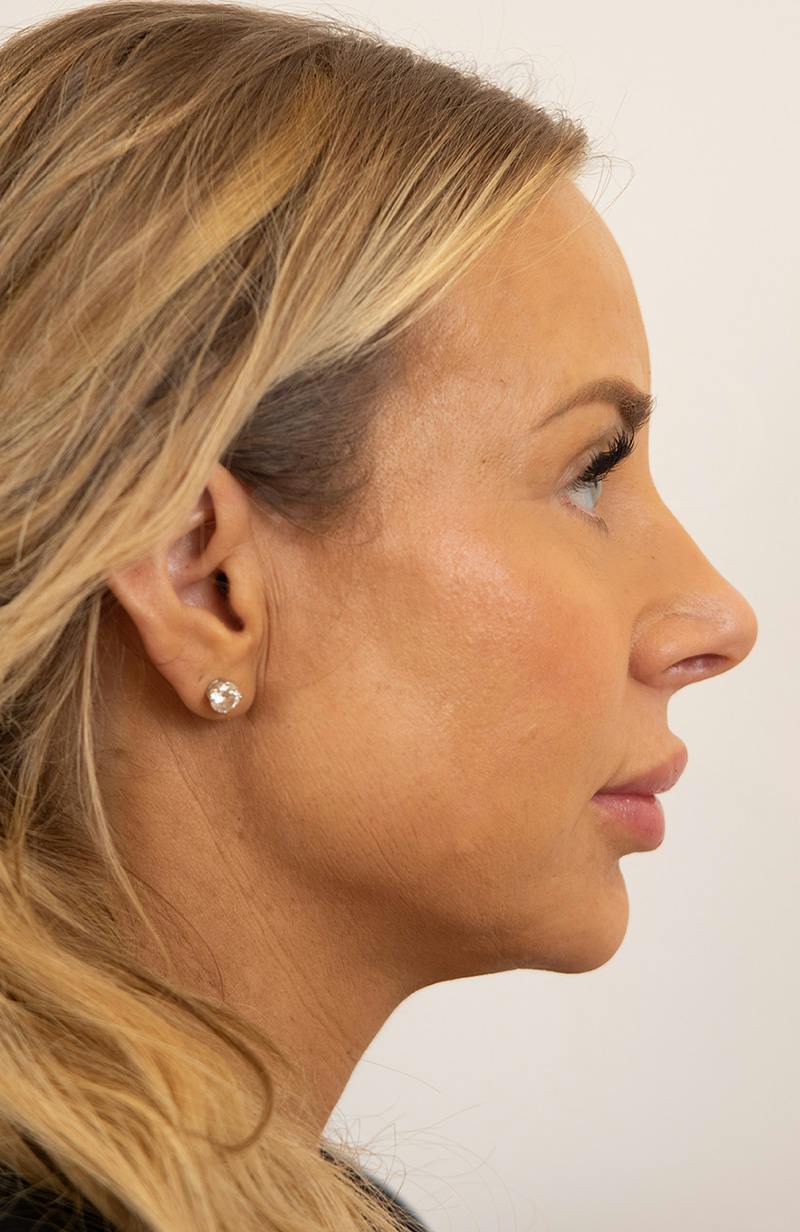 Blepharoplasty Before & After Gallery - Patient 119084 - Image 4