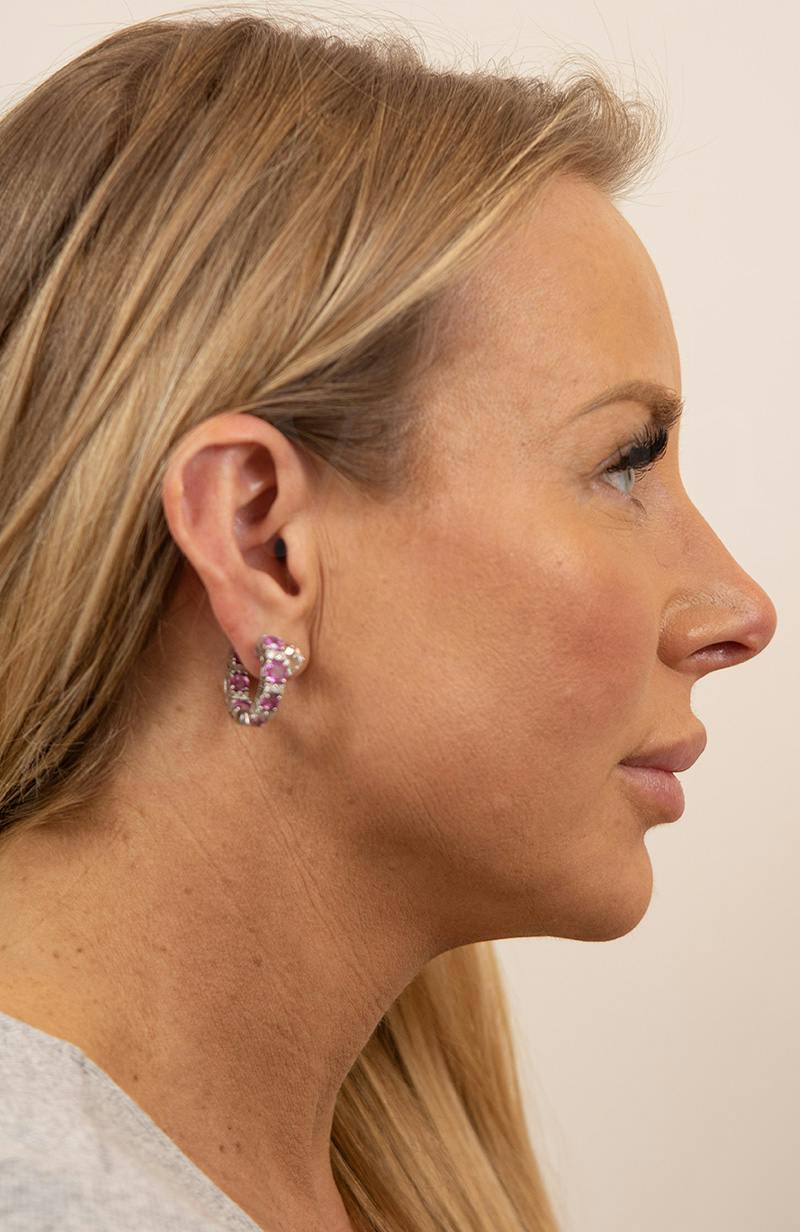 Blepharoplasty Before & After Gallery - Patient 119084 - Image 3