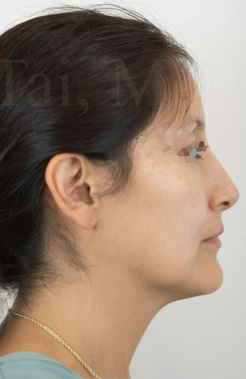 Blepharoplasty Before & After Gallery - Patient 153260 - Image 4