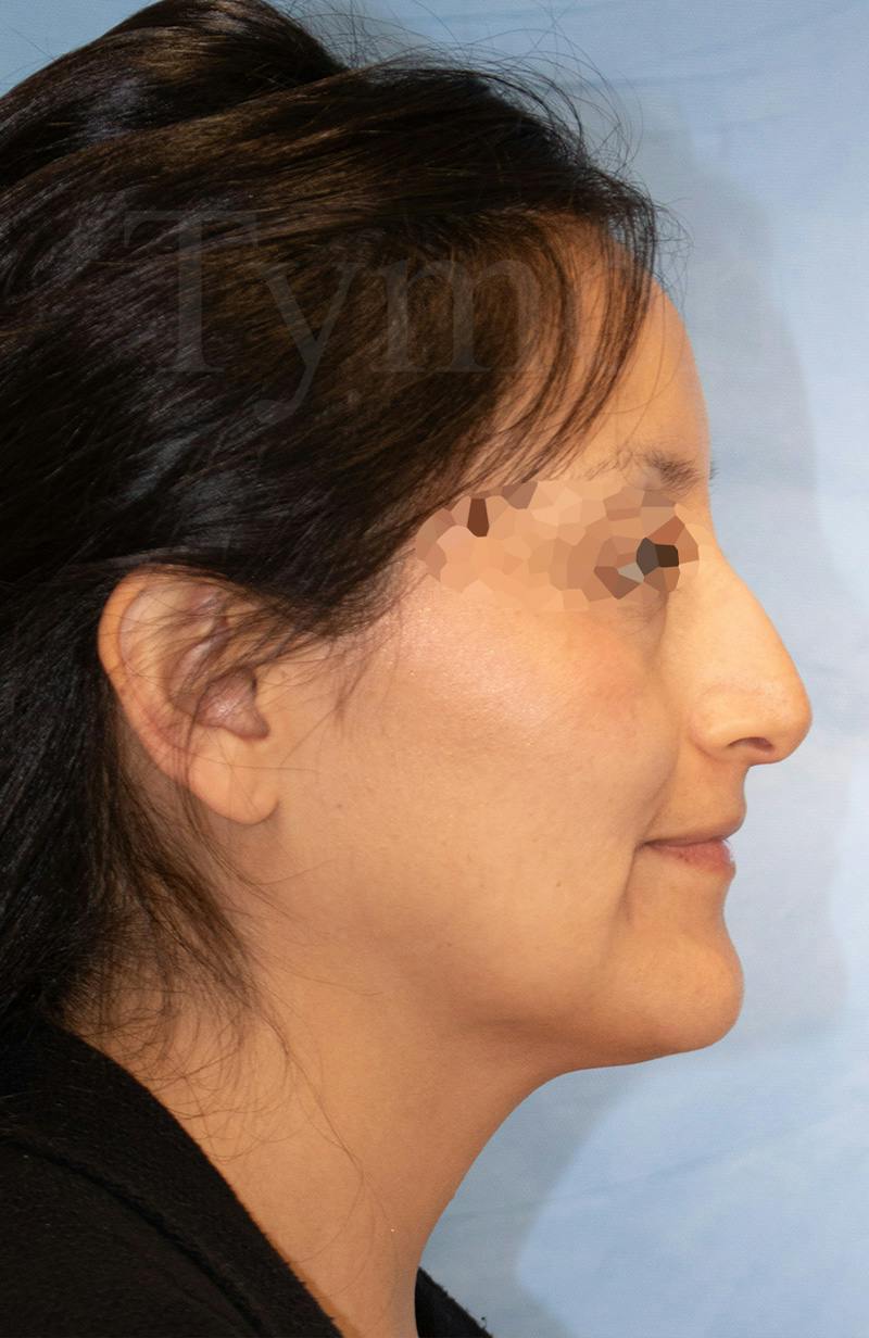 Blepharoplasty Before & After Gallery - Patient 153260 - Image 3