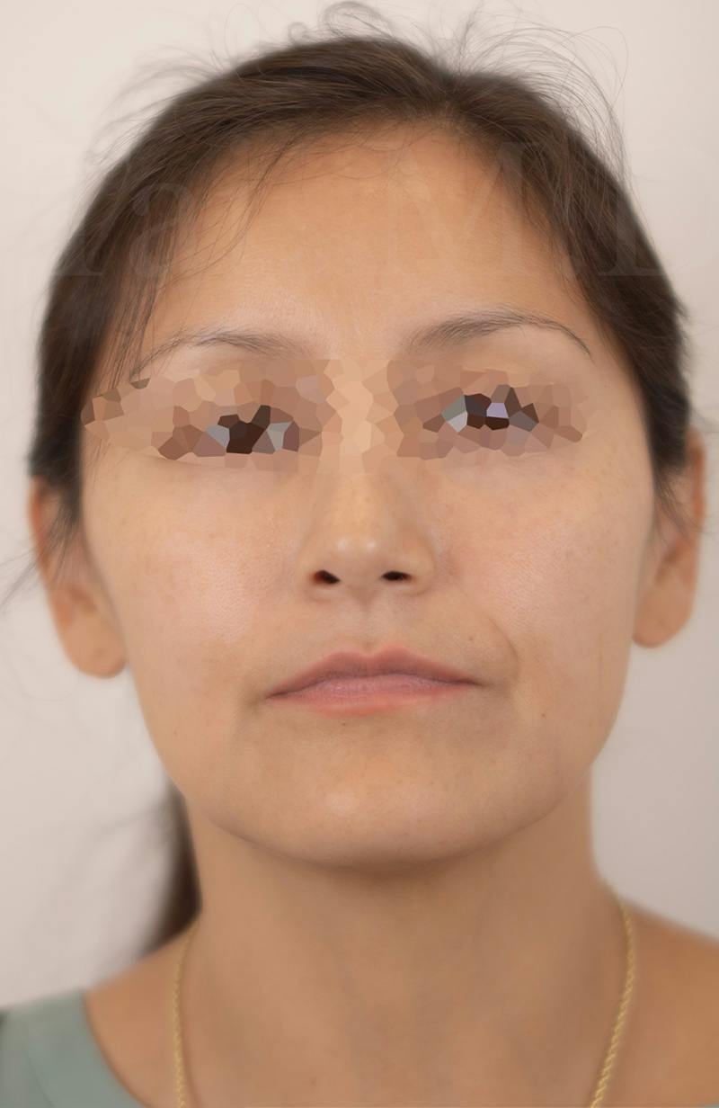 Blepharoplasty Before & After Gallery - Patient 153260 - Image 2
