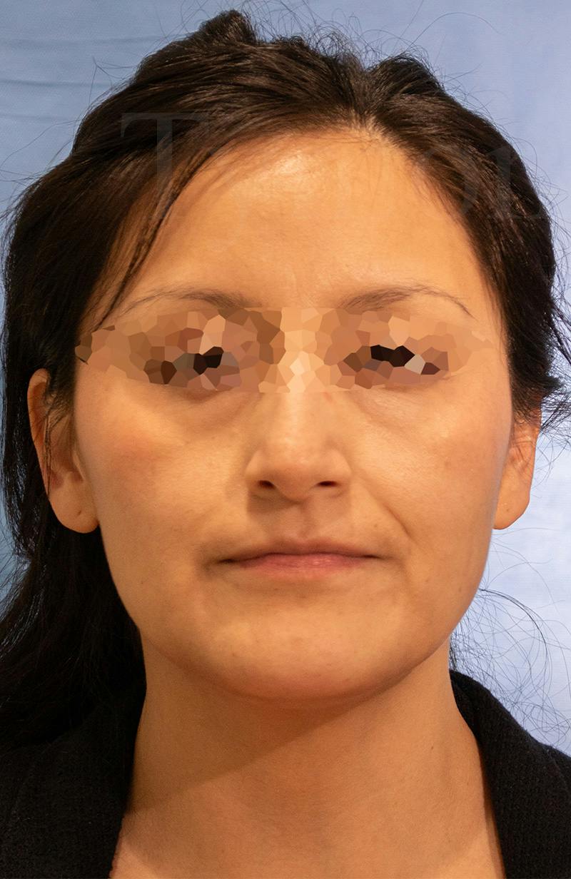 Blepharoplasty Before & After Gallery - Patient 153260 - Image 1