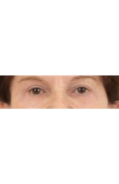 Blepharoplasty Before & After Gallery - Patient 427826 - Image 2