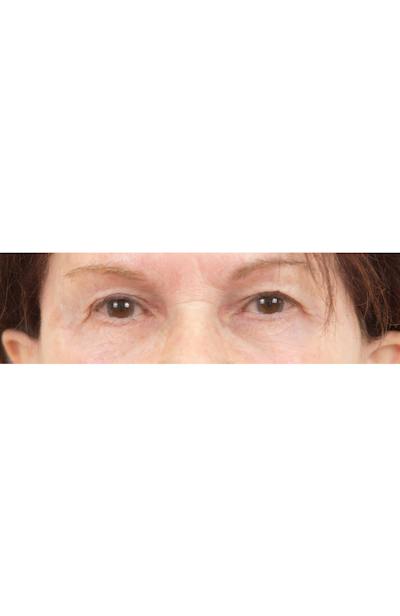 Blepharoplasty Before & After Gallery - Patient 427826 - Image 1