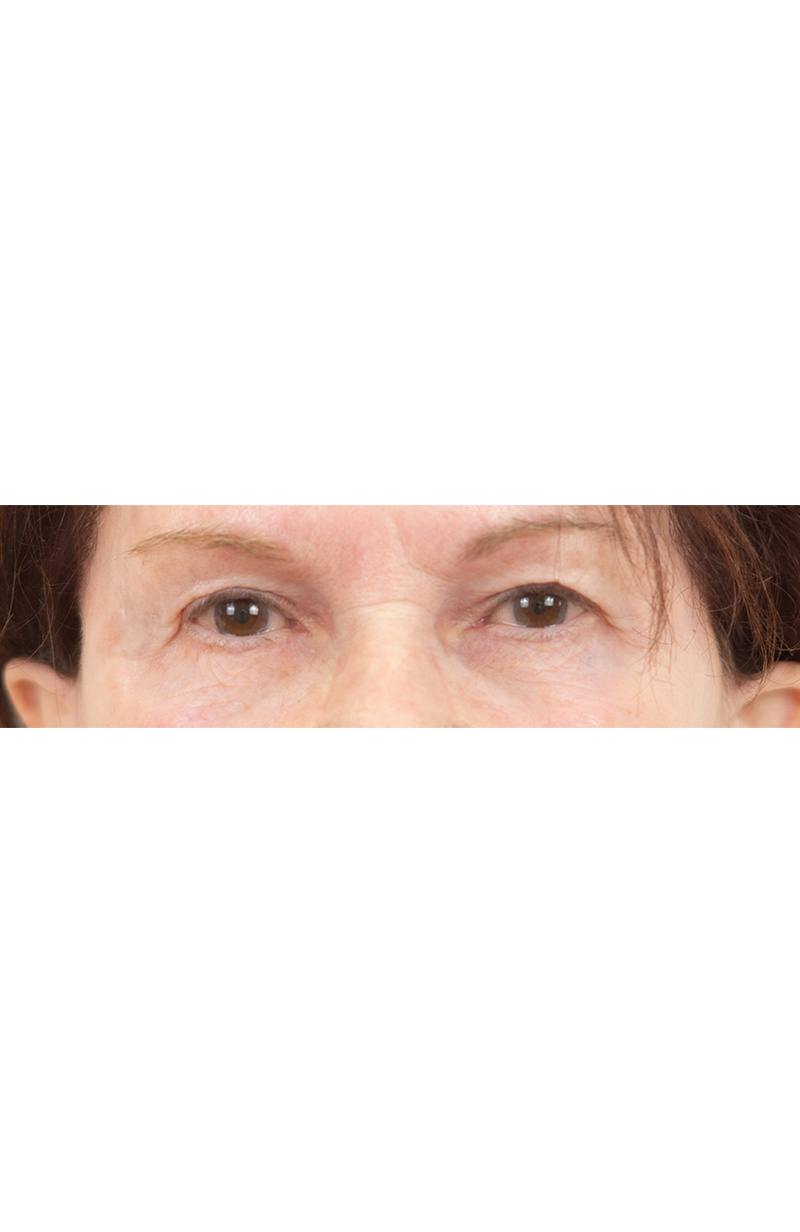 Blepharoplasty Before & After Gallery - Patient 427826 - Image 1