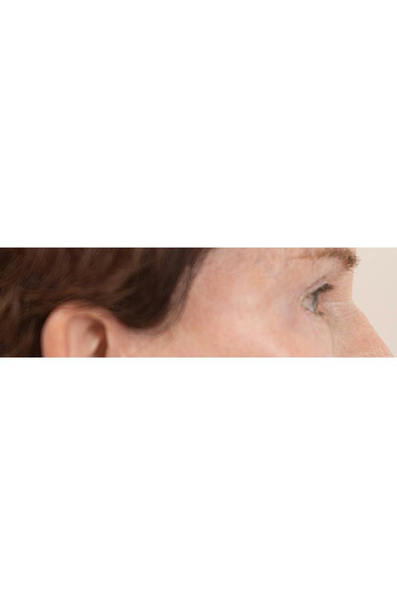 Blepharoplasty Before & After Gallery - Patient 427826 - Image 4