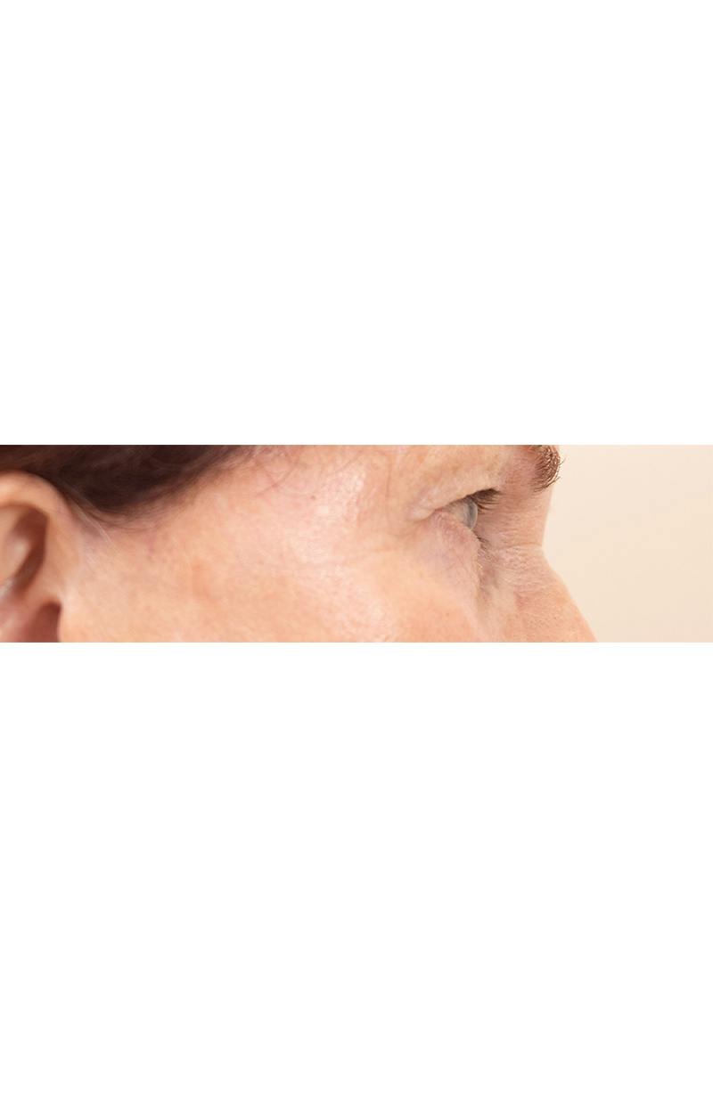 Blepharoplasty Before & After Gallery - Patient 427826 - Image 3