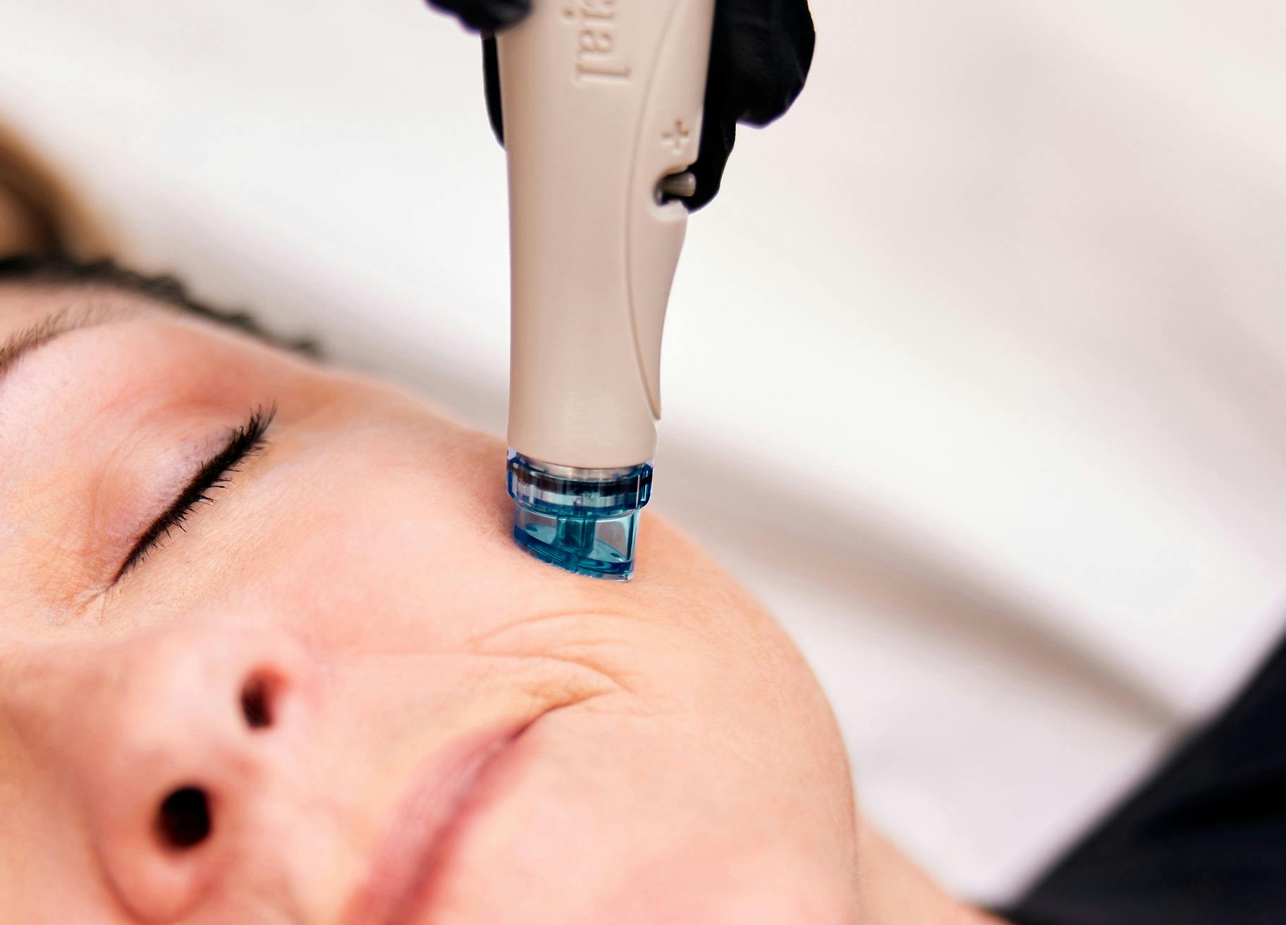 Woman getting a HydraFacial