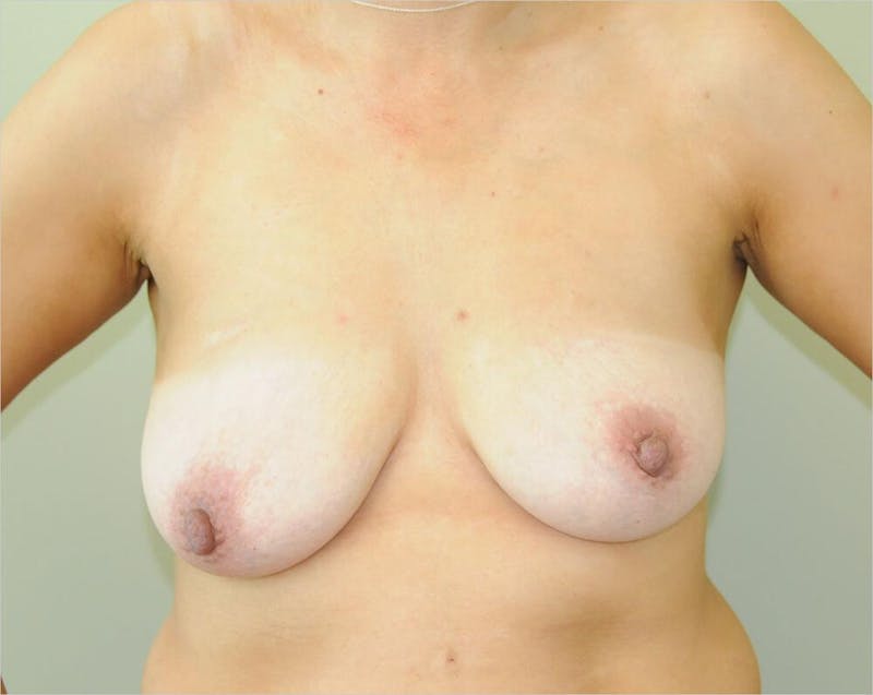 Breast Aug and Lift Before & After Gallery - Patient 191404722 - Image 1