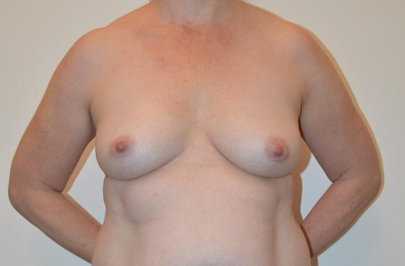 Breast Lift Before & After Gallery - Patient 191404729 - Image 1