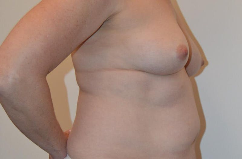 Breast Lift Before & After Gallery - Patient 191404729 - Image 3