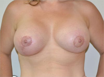 Breast Aug and Lift Before & After Gallery - Patient 191404734 - Image 2