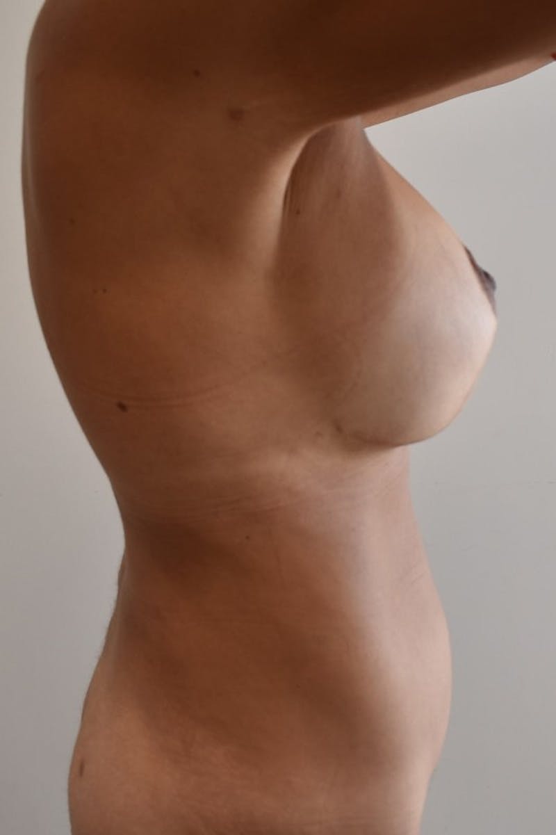 Breast Augmentation Before & After Gallery - Patient 191404730 - Image 4