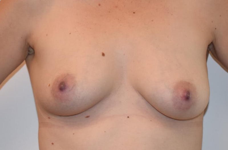 Breast Lift Before & After Gallery - Patient 191404735 - Image 1