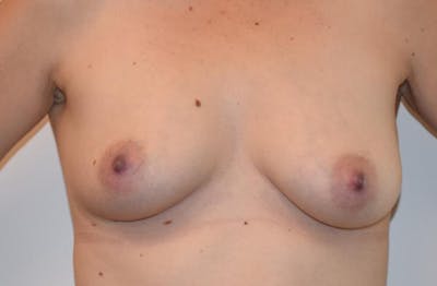 Breast Lift Before & After Gallery - Patient 191404735 - Image 1