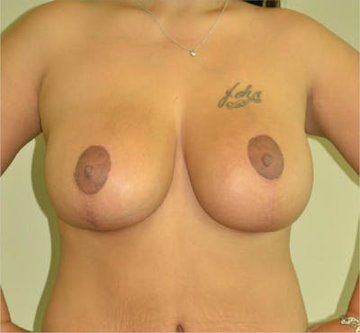 Breast Aug and Lift Before & After Gallery - Patient 191404761 - Image 2