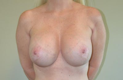 Breast Lift Before & After Gallery - Patient 191404738 - Image 2