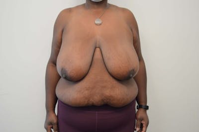 Breast Reduction Before & After Gallery - Patient 191404740 - Image 1