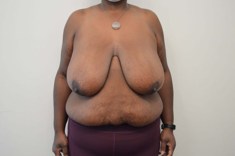 Breast Reduction Before & After Gallery - Patient 191404740 - Image 1