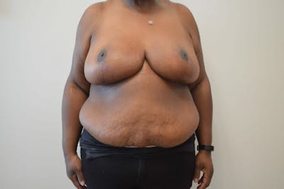 Breast Reduction Before & After Gallery - Patient 191404740 - Image 2
