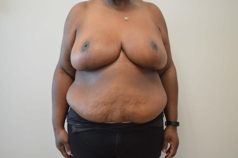 Breast Reduction Before & After Gallery - Patient 191404740 - Image 2