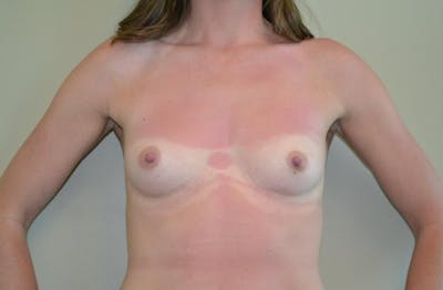 Breast Augmentation Before & After Gallery - Patient 191404745 - Image 1