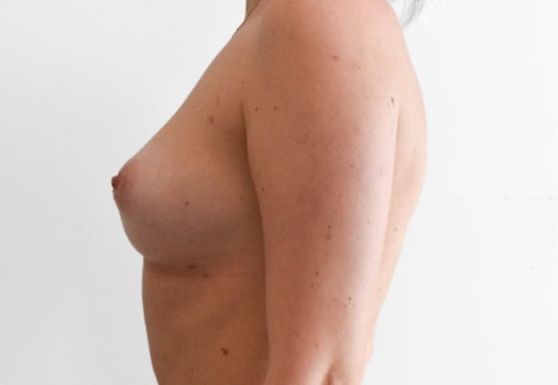 Fat Transfer Breast Augmentation Before & After Gallery - Patient 191404796 - Image 6