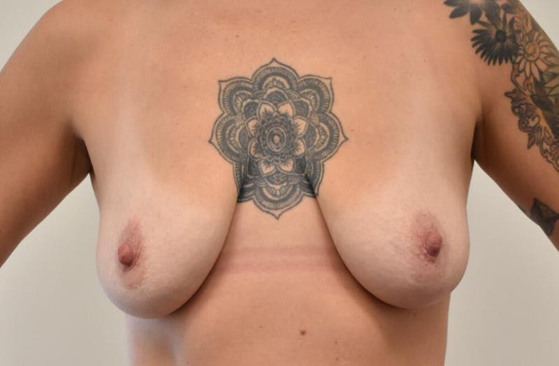 Breast Lift Before & After Gallery - Patient 191404801 - Image 1