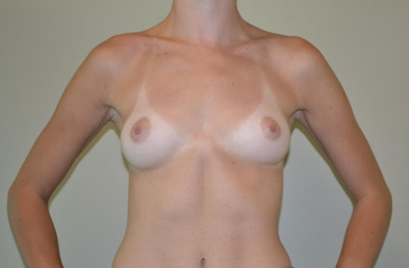 Breast Augmentation Before & After Gallery - Patient 191404808 - Image 1