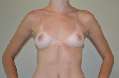 Breast Augmentation Before & After Gallery - Patient 191404808 - Image 1