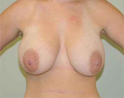 Breast Lift Before & After Gallery - Patient 191404816 - Image 1