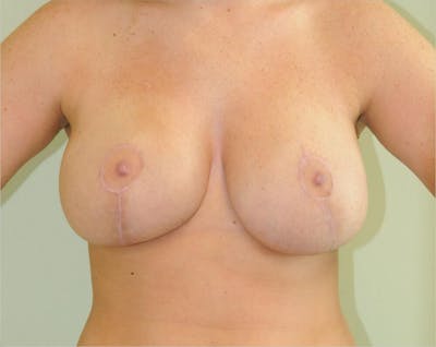 Breast Lift Before & After Gallery - Patient 191404816 - Image 2