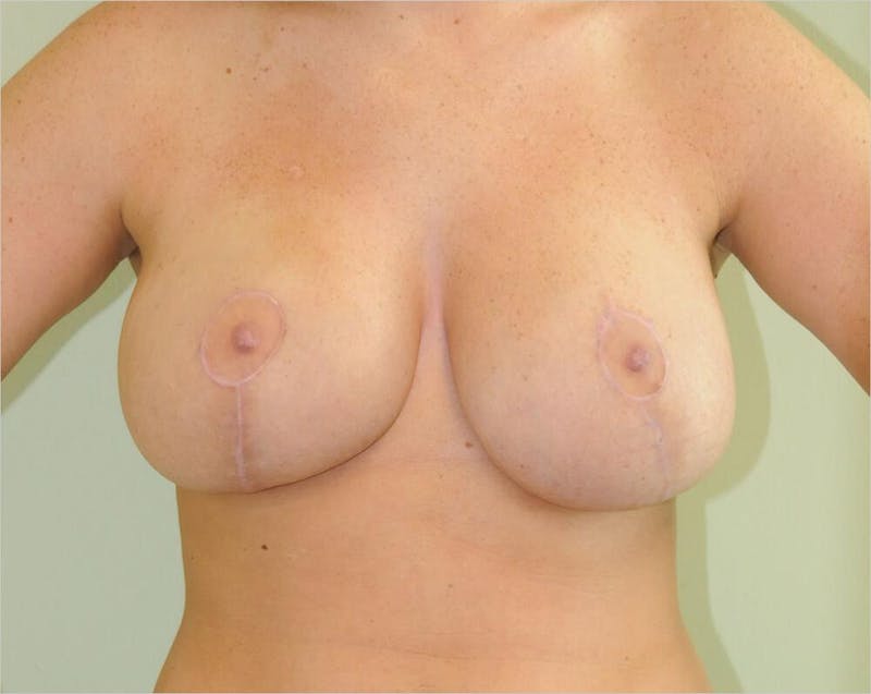 Breast Lift Before & After Gallery - Patient 191404816 - Image 2