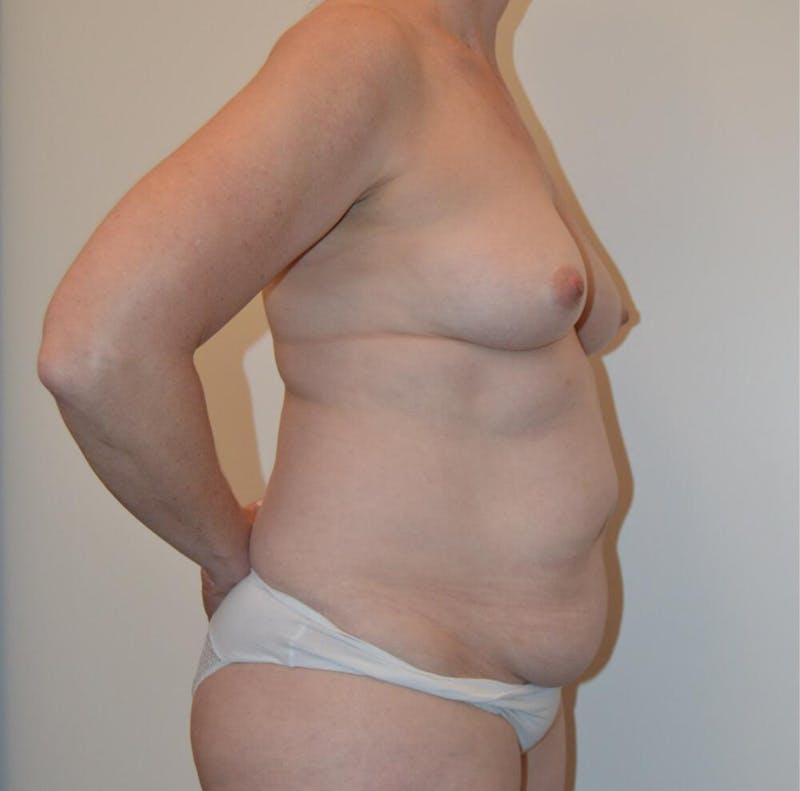 Mommy Makeover Before & After Gallery - Patient 191404811 - Image 3