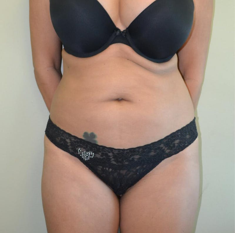 Liposuction Before & After Gallery - Patient 191404824 - Image 1