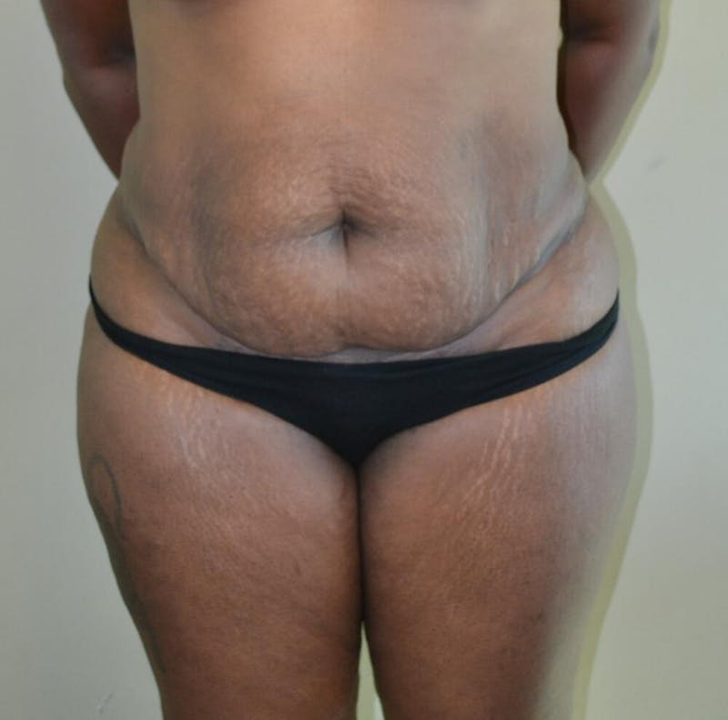 Tummy Tuck Before & After Gallery - Patient 191404833 - Image 1