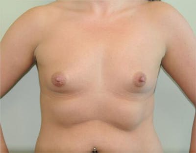 Breast Augmentation Before & After Gallery - Patient 191404901 - Image 1