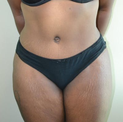 Tummy Tuck Before & After Gallery - Patient 191404833 - Image 2