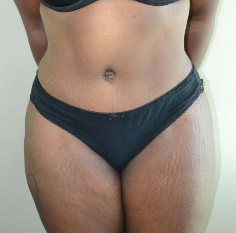 Tummy Tuck Before & After Gallery - Patient 191404833 - Image 2
