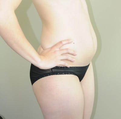 Liposuction Before & After Gallery - Patient 191404834 - Image 1