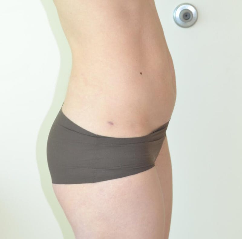 Liposuction Before & After Gallery - Patient 191404834 - Image 2
