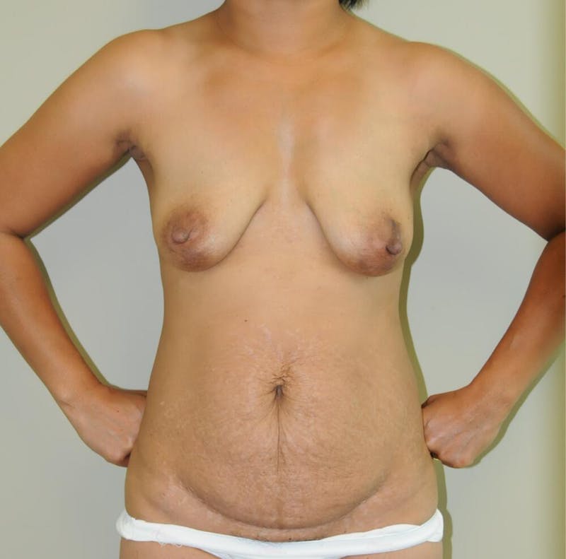 Mommy Makeover Before & After Gallery - Patient 191404837 - Image 1