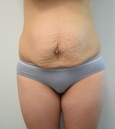 Tummy Tuck Before & After Gallery - Patient 191404836 - Image 1
