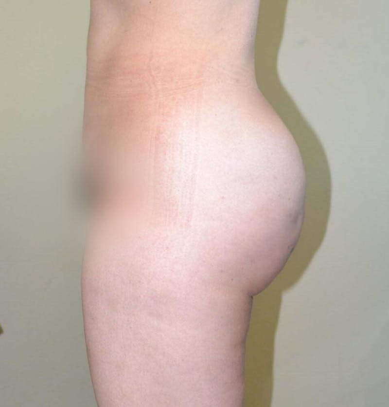 Brazilian Butt Lift Before & After Gallery - Patient 191404835 - Image 2