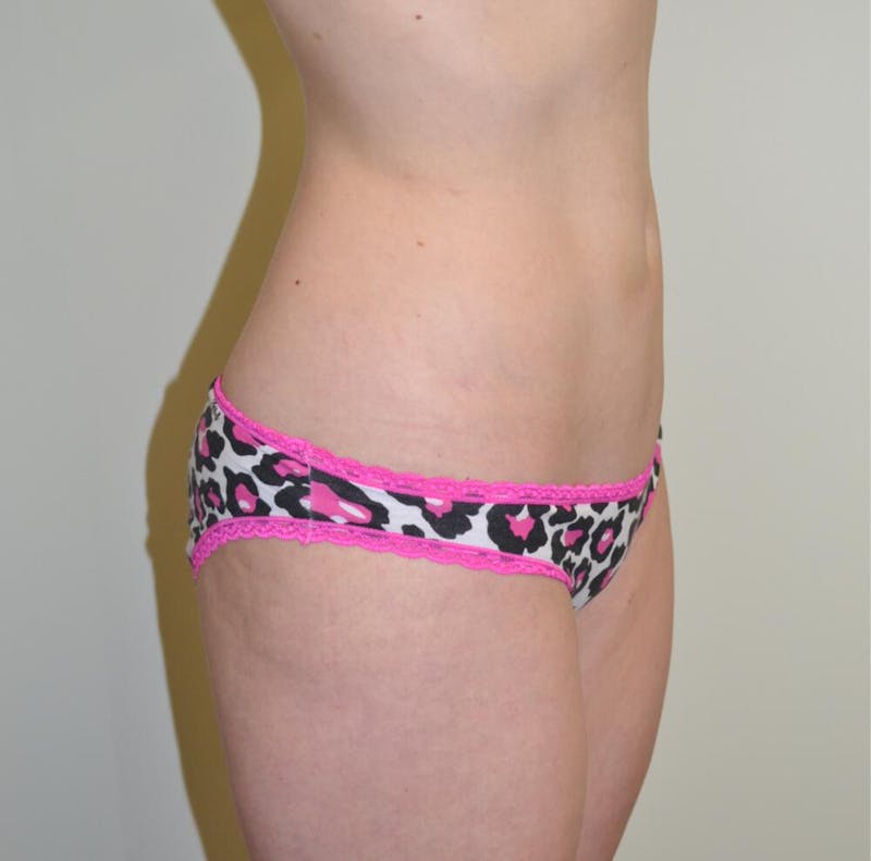 Liposuction Before & After Gallery - Patient 191404838 - Image 2
